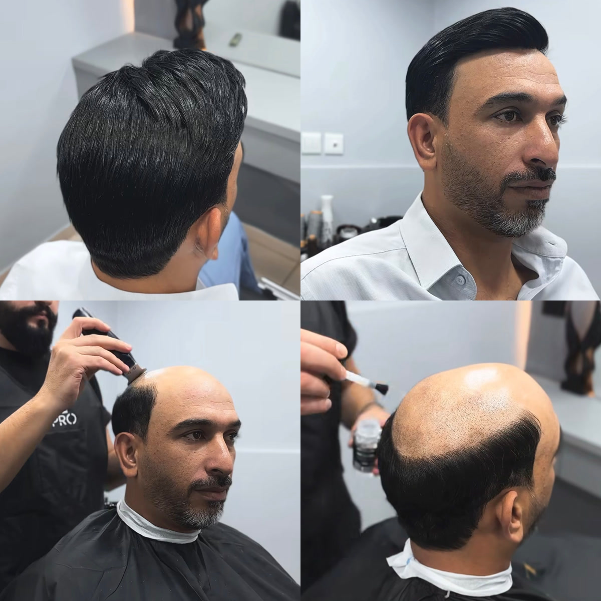 Hair Replacement Systems